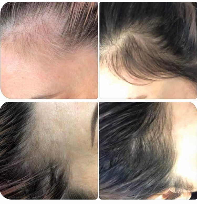 ProCell Therapies Device for Hair Loss | ProCell Microneedling Serums